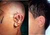 Việt Nam thực hiện thường quy kỹ thuật phẫu thuật tạo hình dị tật tai nhỏ tiên tiến nhất thế giới