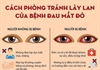 Nghệ An: Số trẻ đau mắt đỏ tăng đột biến